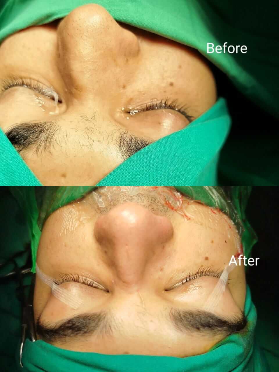 Rhinoplasty