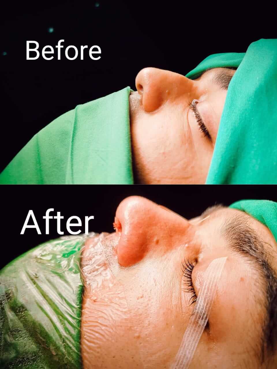 Endoscopic Sinus Surgery (FESS)