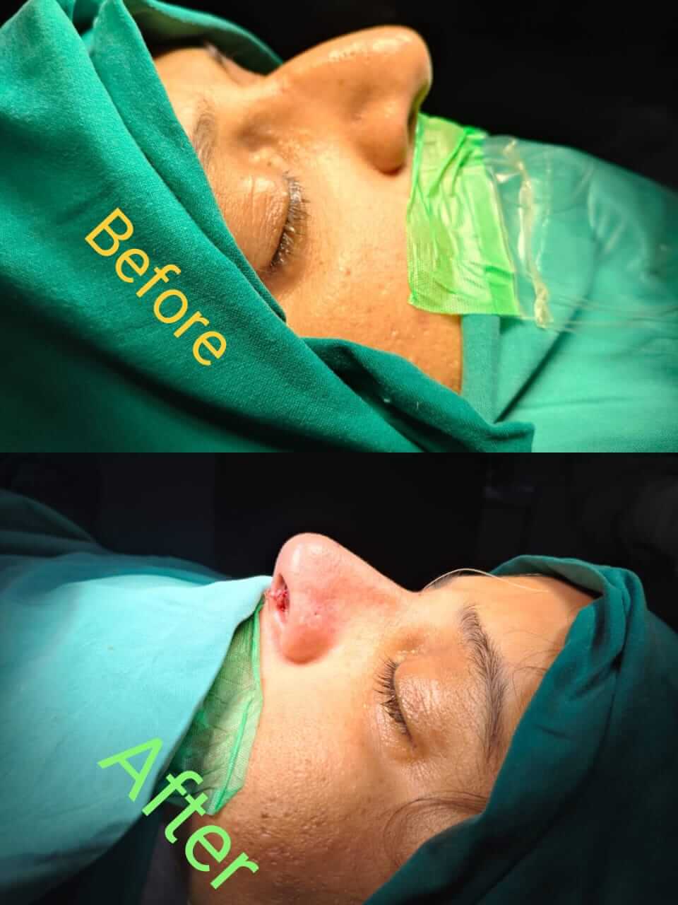 Septoplasty