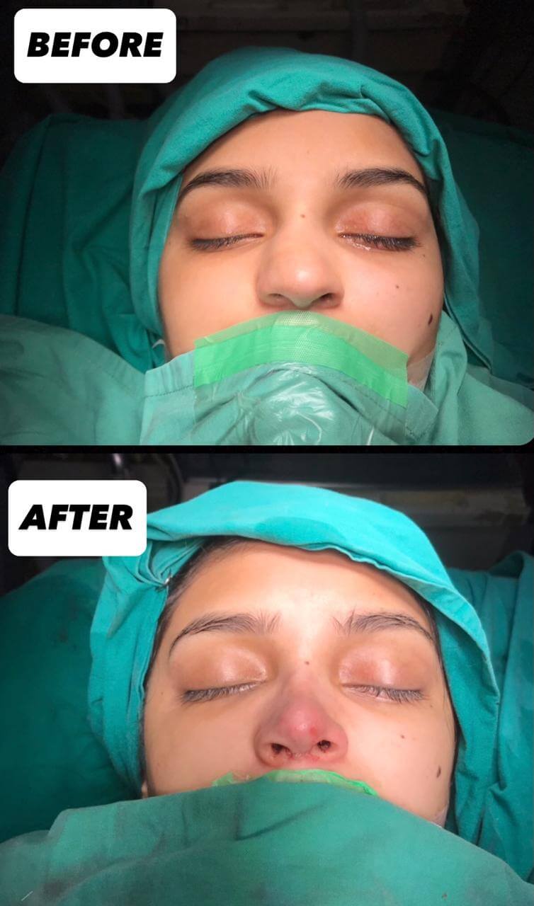 Rhinoplasty