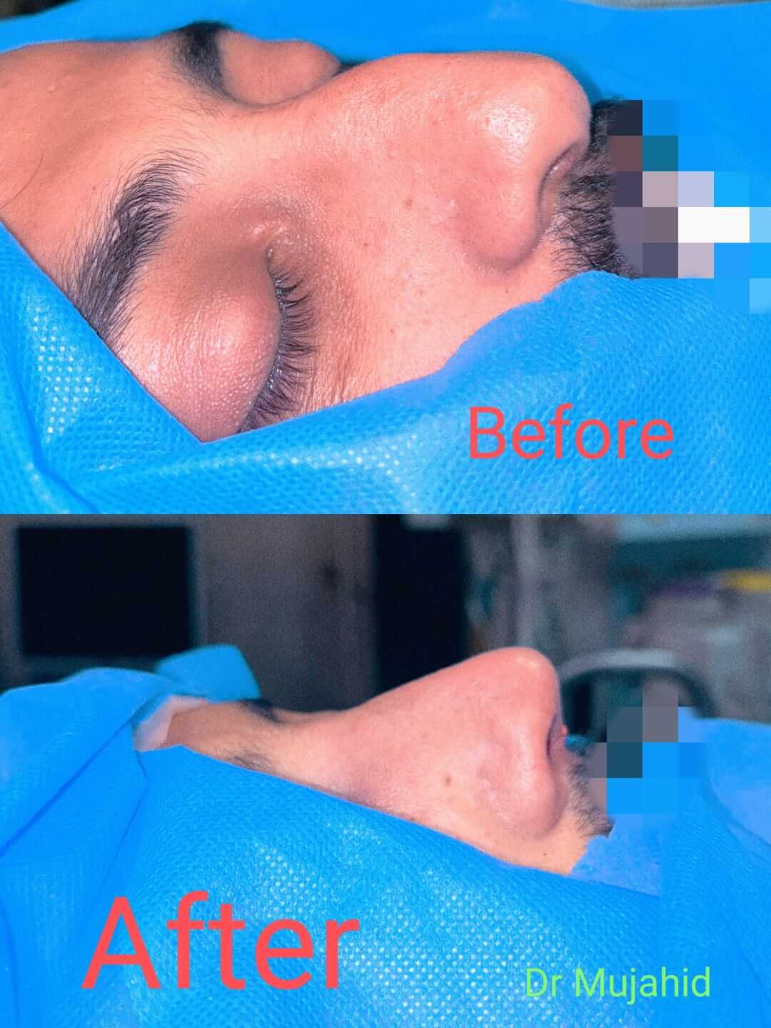 Endoscopic Sinus Surgery (FESS)