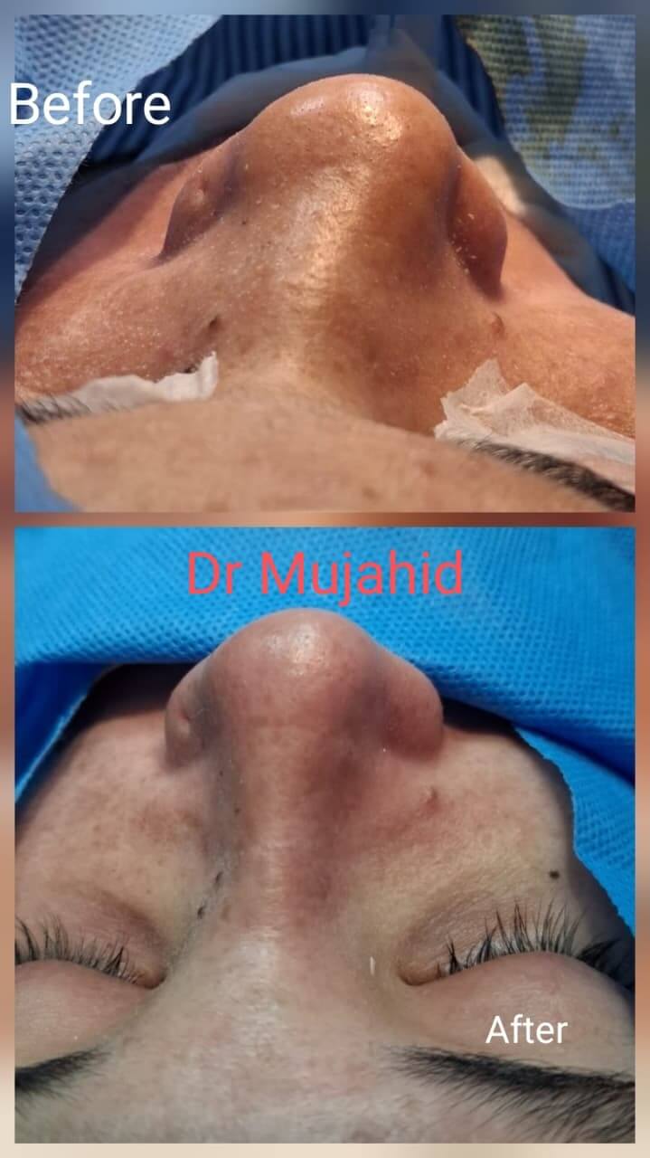 Endoscopic Sinus Surgery (FESS)