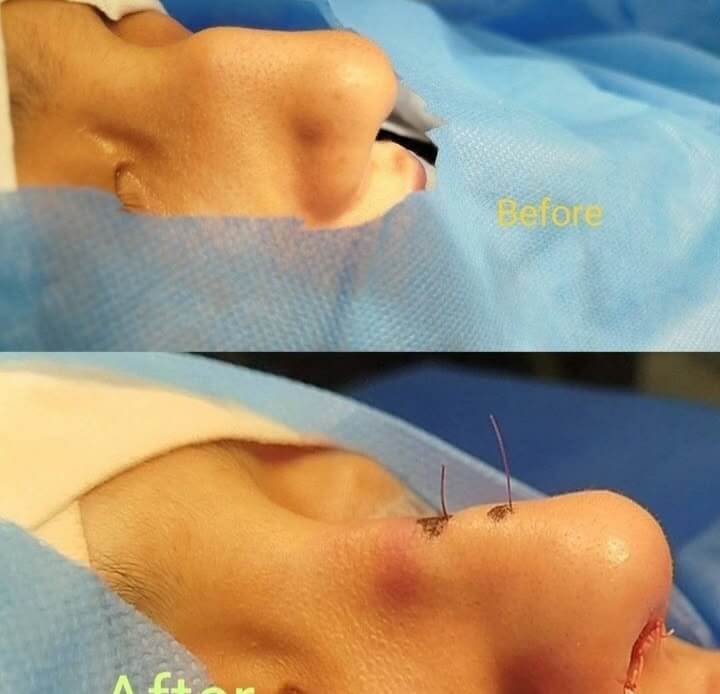 Endoscopic Sinus Surgery (FESS)