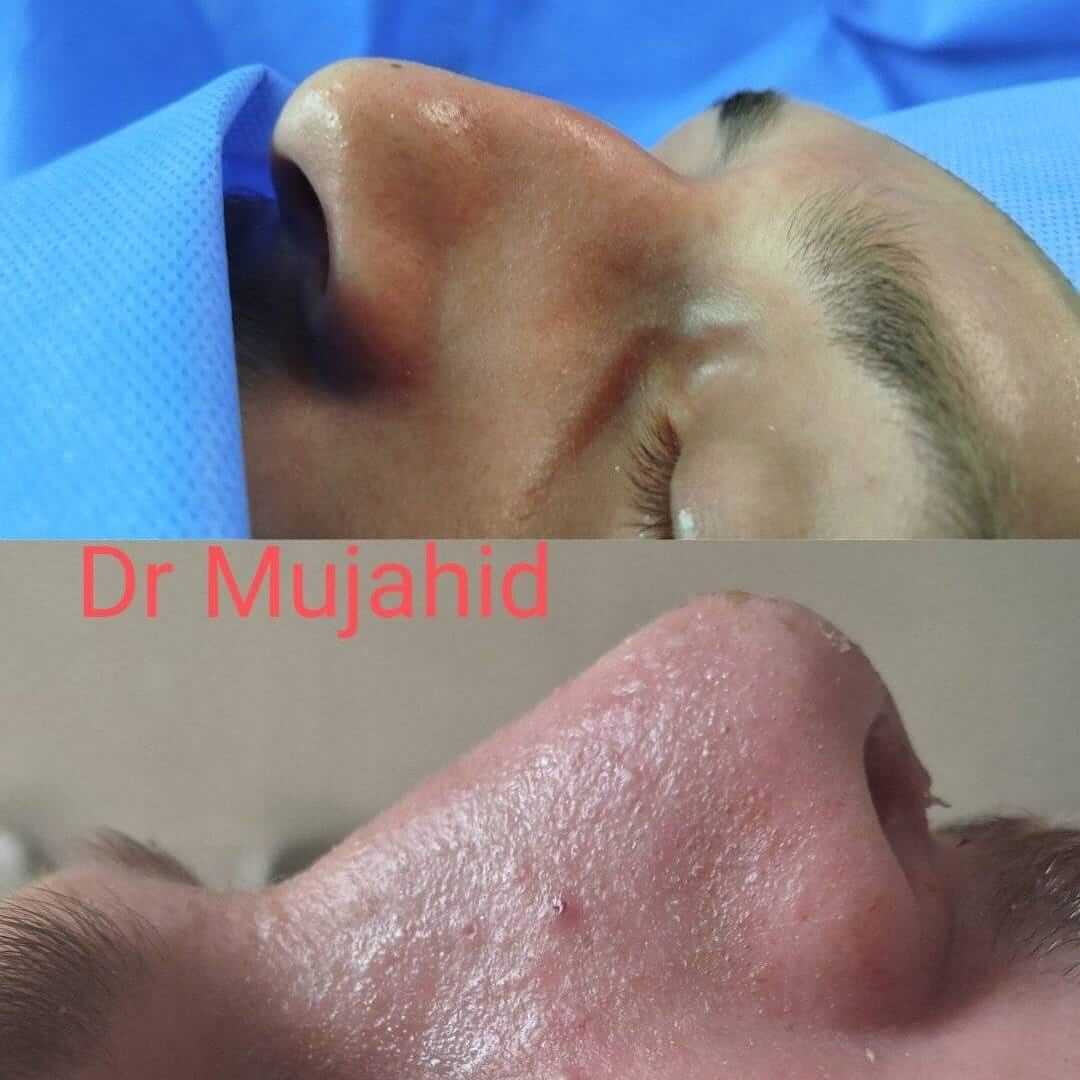 Endoscopic Sinus Surgery (FESS)