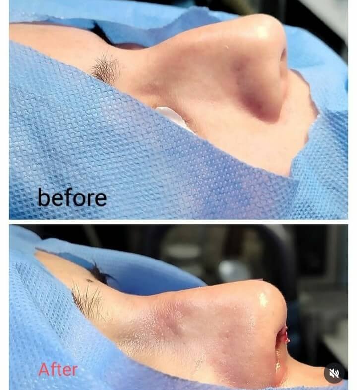 Endoscopic Sinus Surgery (FESS)