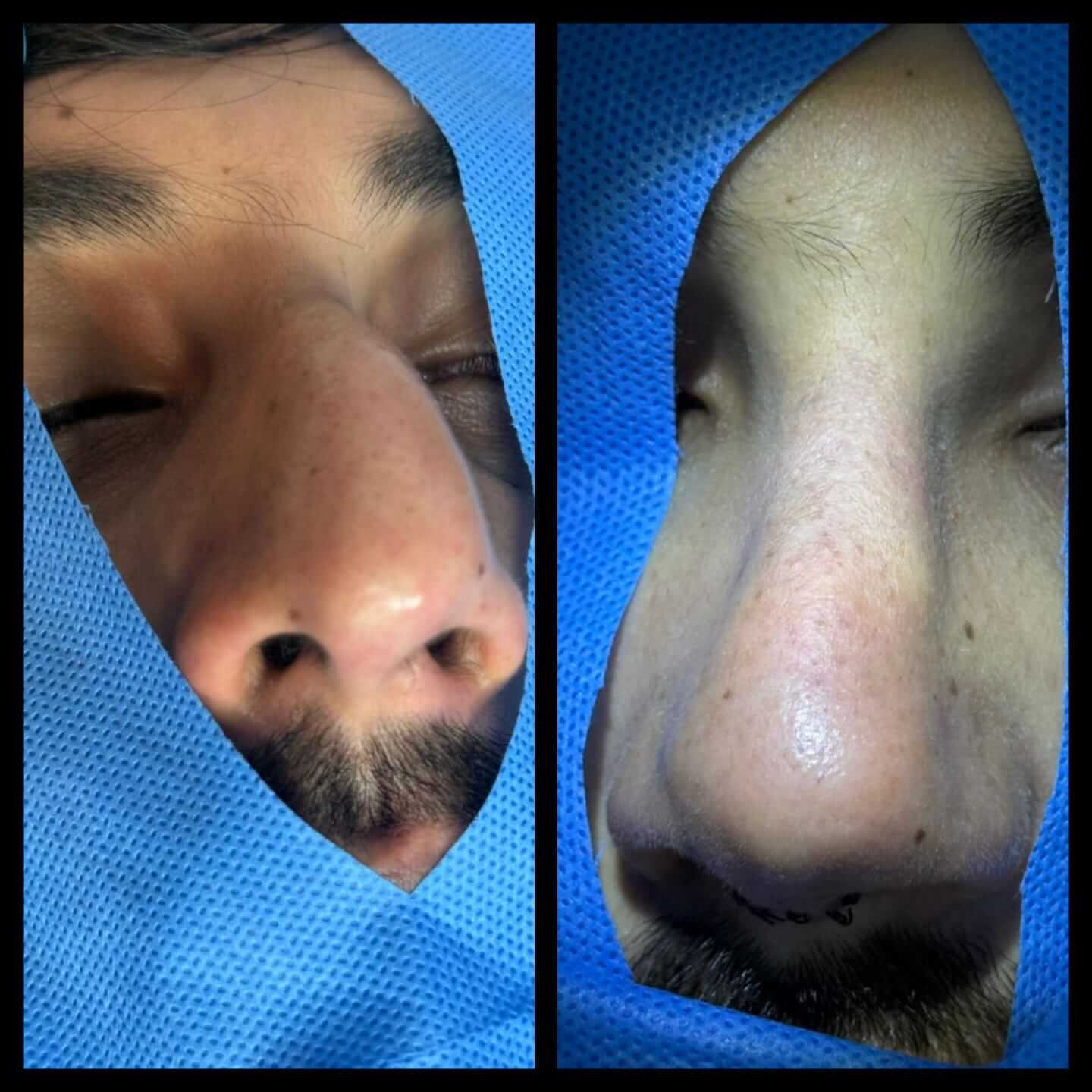 Endoscopic Sinus Surgery (FESS)