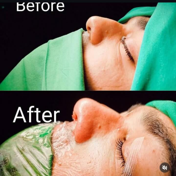 Endoscopic Sinus Surgery (FESS)