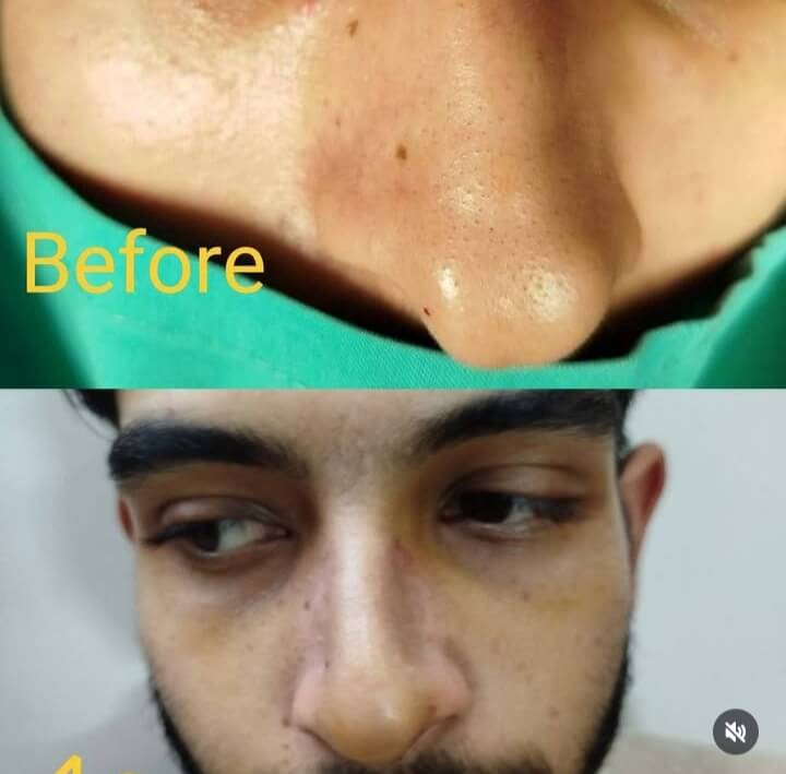 Endoscopic Sinus Surgery (FESS)