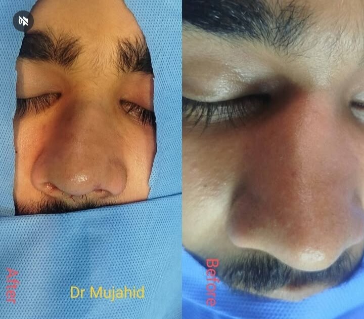 Endoscopic Sinus Surgery (FESS)